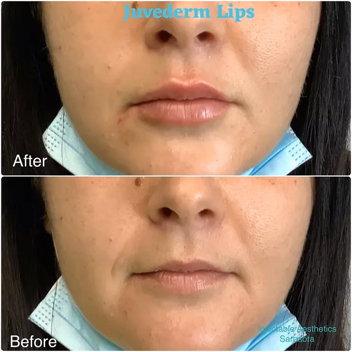 Side profile before and after photos demonstrating a sharper, more defined jawline and improved chin projection with structural fillers.