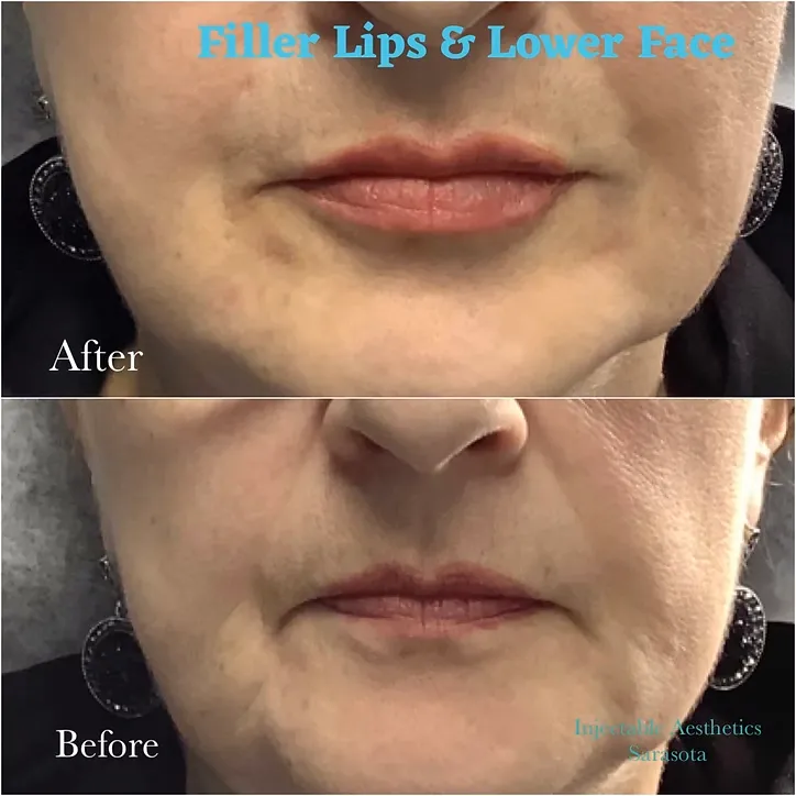 Before and after comparison showing restored cheek volume and softened nasolabial folds using dermal fillers for a youthful lift.