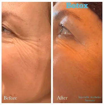 Before and after comparison showing the significant reduction of crow's feet wrinkles around the eyes following Botox treatment.