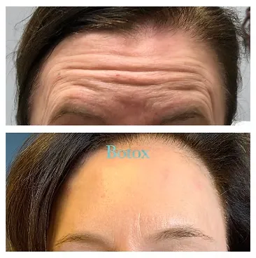 Before and after photos illustrating the significant improvement in deep horizontal forehead wrinkles achieved through Botox injections.