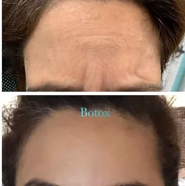 Before and after comparison of a patient's forehead, highlighting the effective reduction of dynamic expression lines with Botox.