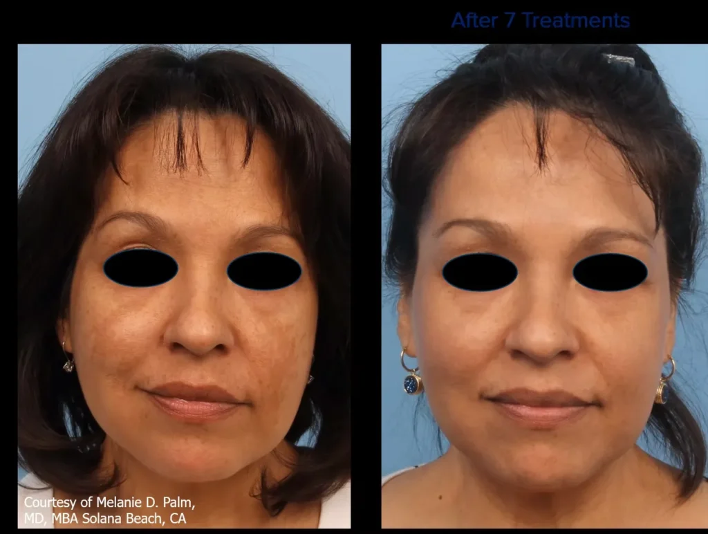 Side profile before and after photos demonstrating a sharper, more defined jawline and improved chin projection with structural fillers.