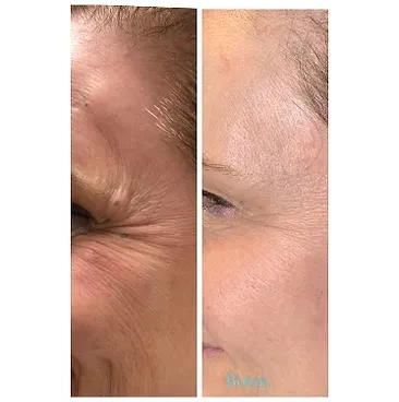 Side profile comparison before and after Botox, showing a noticeable decrease in the depth and visibility of lateral canthal lines (crow's feet).