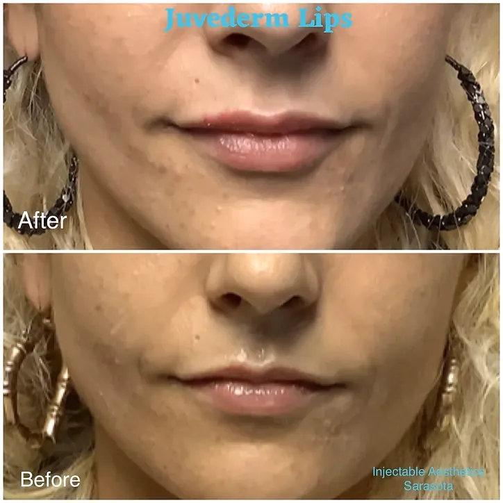 Profile view comparison showing the enhancement of the jawline and chin area using dermal fillers to create a distinct, youthful profile.
