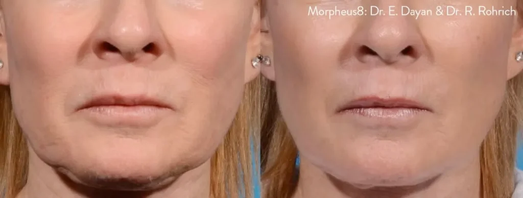 Before and after comparison showing the reduction of jowls and tightening of the lower face and jawline using Morpheus8.