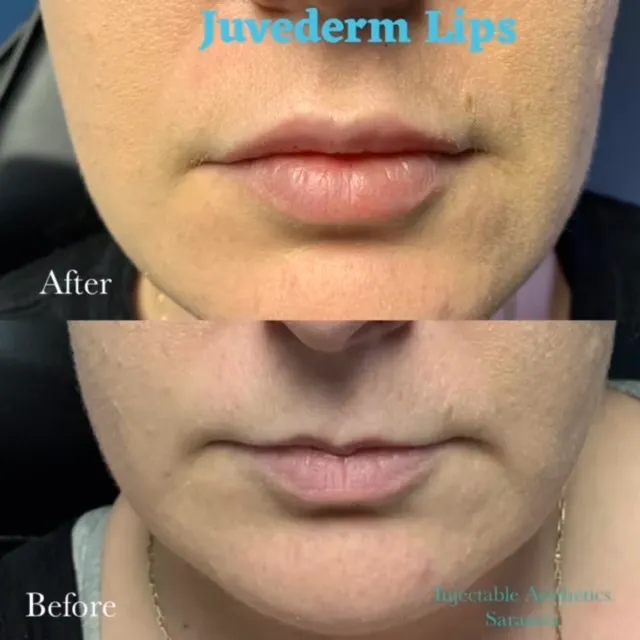 Before and after results of full facial balancing with dermal fillers on mature skin, showing improved volume, hydration, and reduced wrinkles.