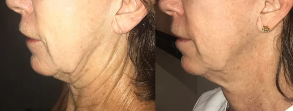 Before and after photos demonstrating the non-surgical lifting of hooded eyelids and tightening of skin around the eyes with Morpheus8.