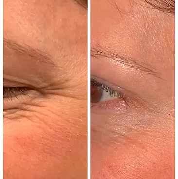 Close-up view before and after Botox treatment, showing visibly smoother skin and diminished fine lines around the outer eye area.