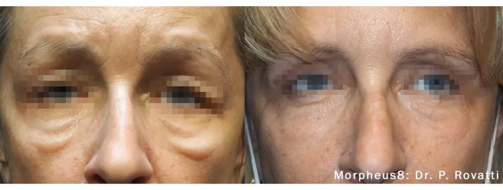 Before and after results of Morpheus8 treatment for smoothing under-eye bags and improving skin crepiness around the orbital area.
