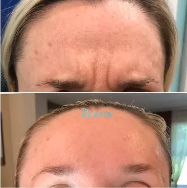 Before and after results showing the smoothing of wrinkles in the upper forehead area following a neuromodulator treatment like Botox.