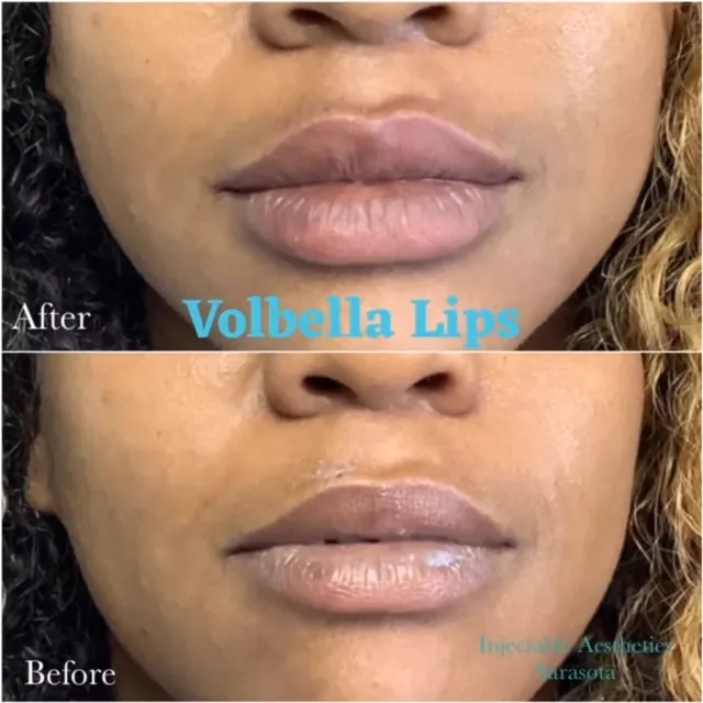 Profile view comparison showing the enhancement of the jawline and chin area using dermal fillers to create a distinct, youthful profile.